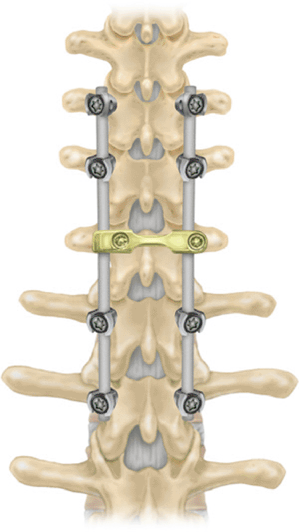 Image: The Medtronic CD Horizon Solera spinal system (photo courtesy Medtronic).